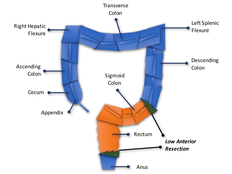 Anatomy of colon and rectum prior to low anterior resection