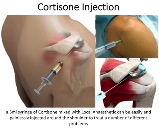 Corticosteroid injections in frozen shoulder Corticosteroid injections in frozen shoulder