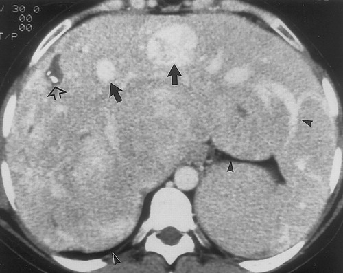 CT Image of hepatic adenoma