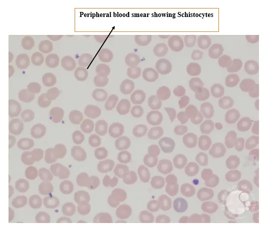 Fragmented red blood cells picture of TTP Fragmented red blood cells picture of TTP