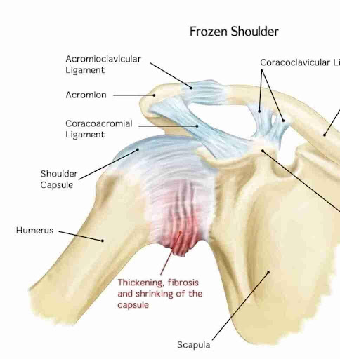 Frozen shoulder disorder Frozen shoulder disorder