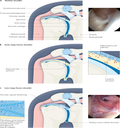 Frozen shoulder schematic diagram Frozen shoulder schematic diagram