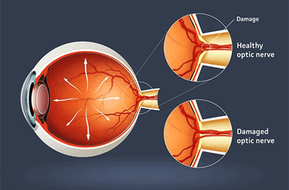 Healthy and damaged optic nerve