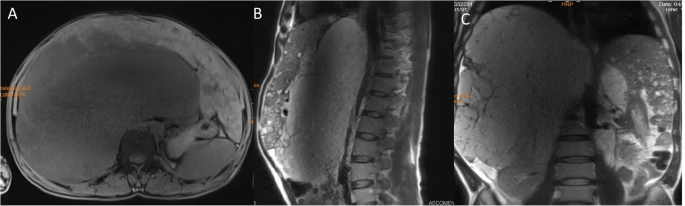 T1-weighted MRI image of liver hemangioma