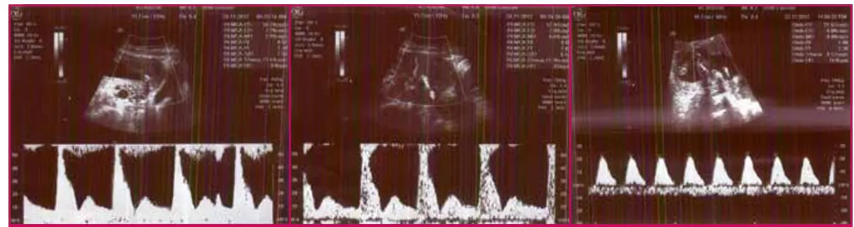 Ultrasound pictures of umbilical artery and uterine artery Ultrasound pictures of umbilical artery and uterine artery